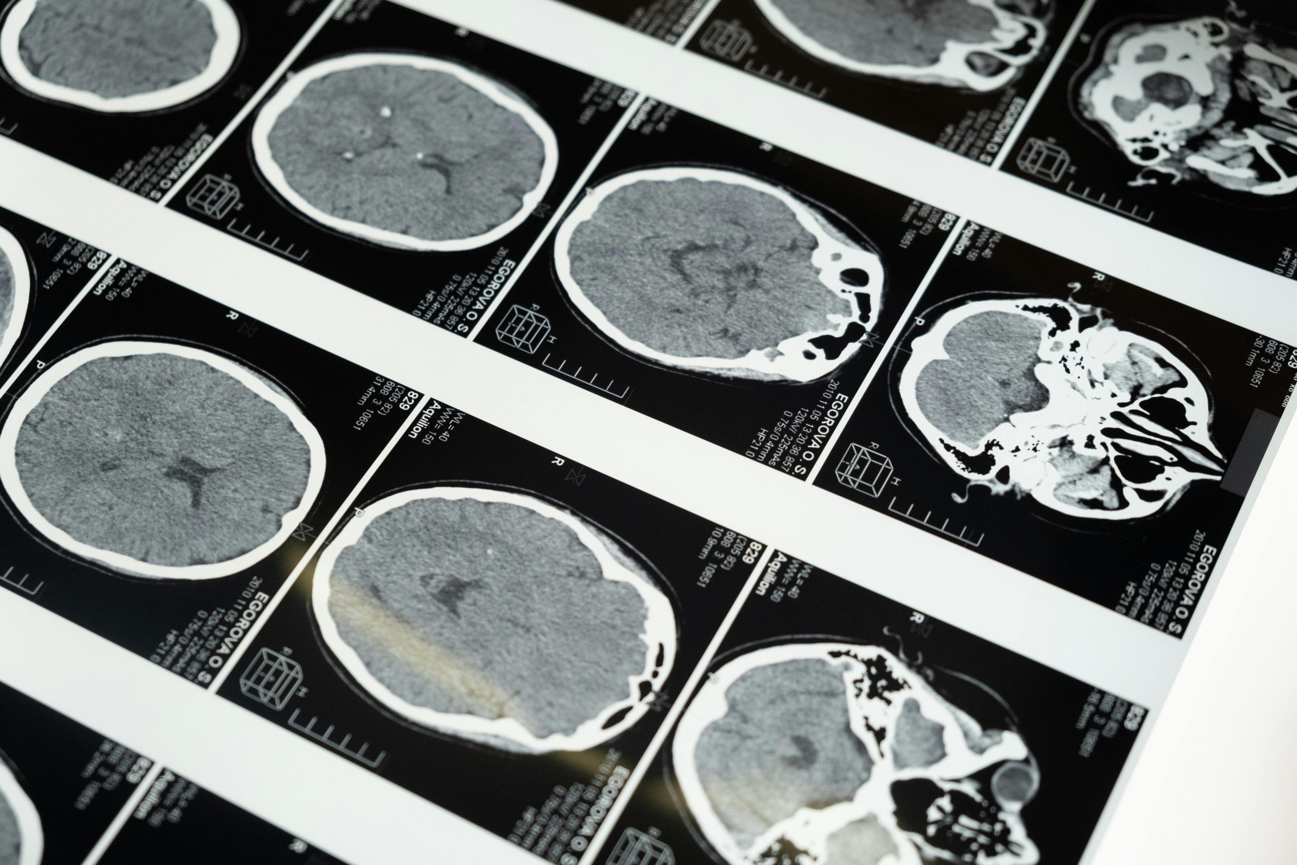 How Do Psychedelics Work? The Entropic Brain Hypothesis